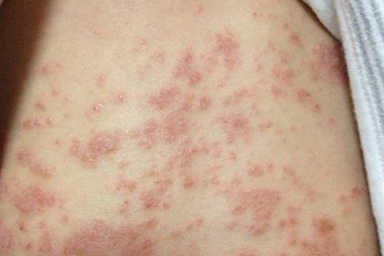 腰部慢性湿疹图 腰部慢性湿疹图