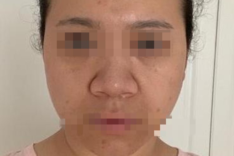 蒜头鼻鼻尖肥大图