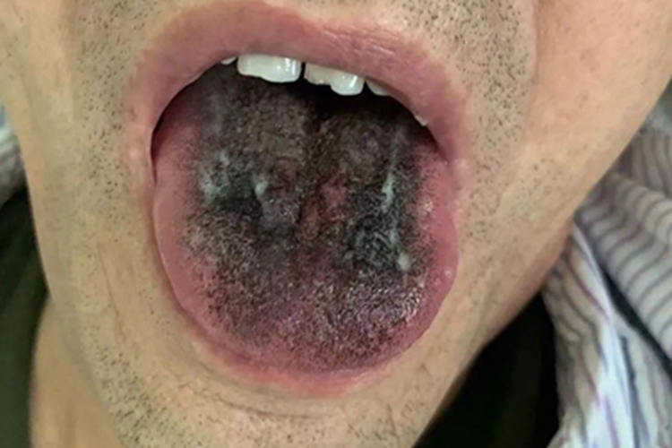 黑毛舌舌头有黑色斑块图 黑毛舌舌头有黑色斑块图