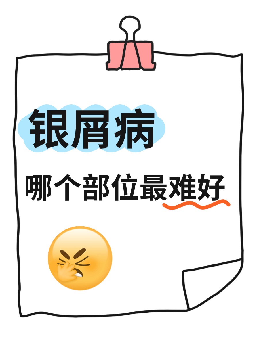 银屑病哪个部位最难好?这几个你绝对想不到!