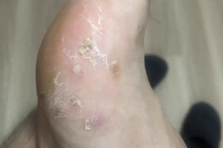 水疱型足癣脚部症状图 水疱型足癣脚部症状图