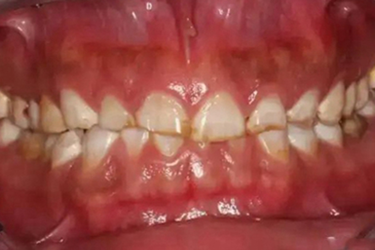 酸蚀症牙齿缺损变短图