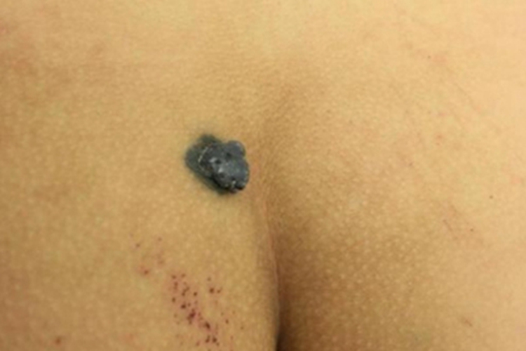 细胞性蓝痣臀部症状图