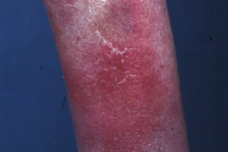 硬结性红斑胳膊红斑图