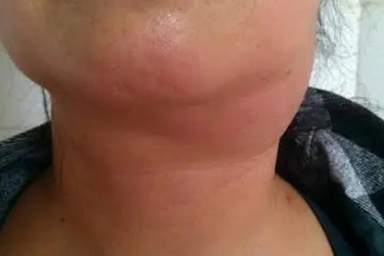 白血病淋巴结肿大图