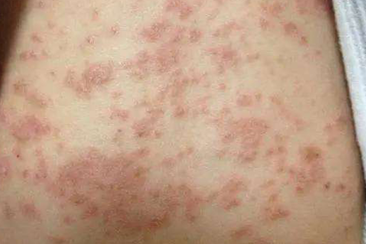 湿疹斑丘疹图