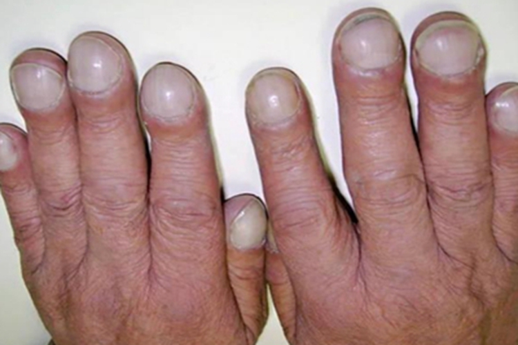 杵状指手指增厚图 杵状指手指增厚图