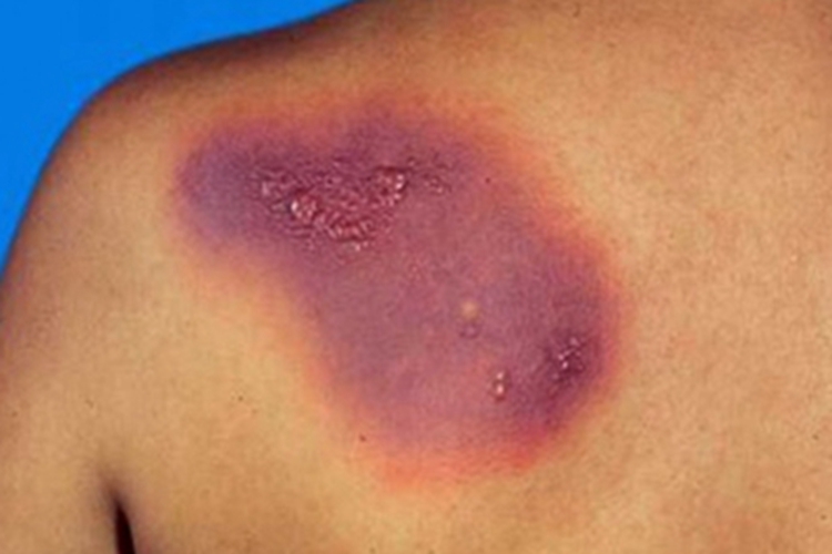 固定型药疹背部症状图 固定型药疹背部症状图