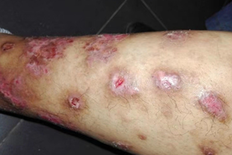 结节性痒疹小腿有溃烂图