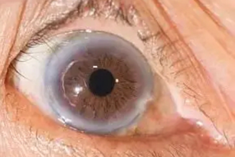 角膜老年环眼球白斑图 角膜老年环眼球白斑图