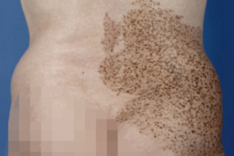 斑痣腰部褐色斑块图