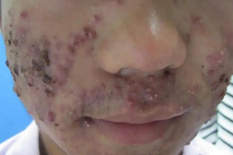 痤疮面部脓疱破溃结黑痂图