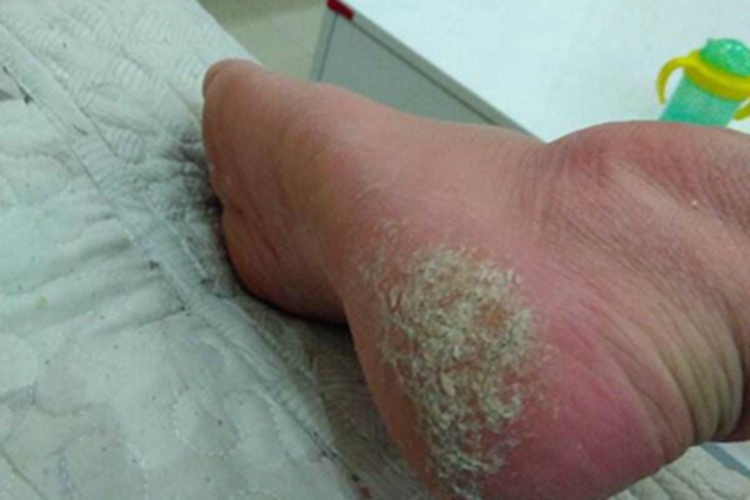 更年期角皮症脚部症状图