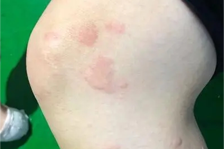 远心性环状红斑风团图