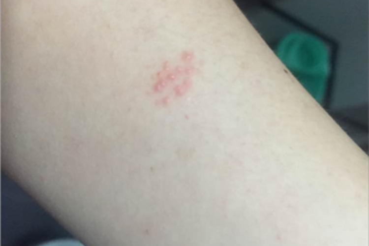 刺毛虫皮炎胳膊症状图 刺毛虫皮炎胳膊症状图