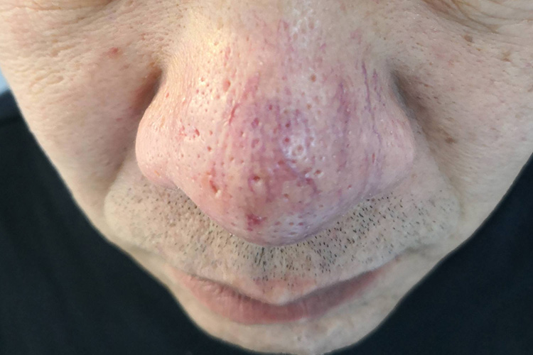 鼻部树枝状毛细血管扩张图