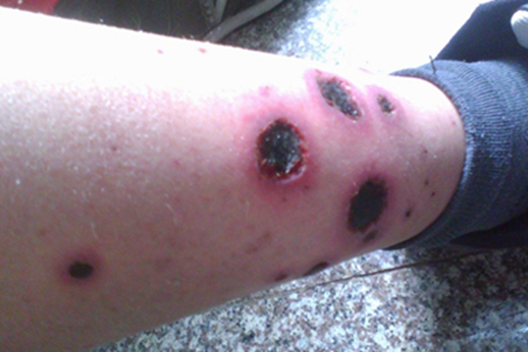 继发性网状青斑溃疡图