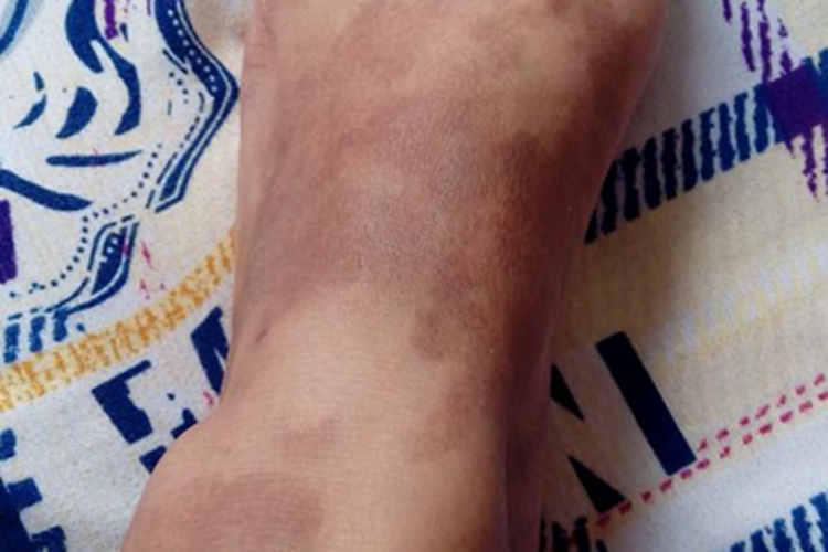 家族性进行性色素沉着脚背斑图 家族性进行性色素沉着脚背斑图