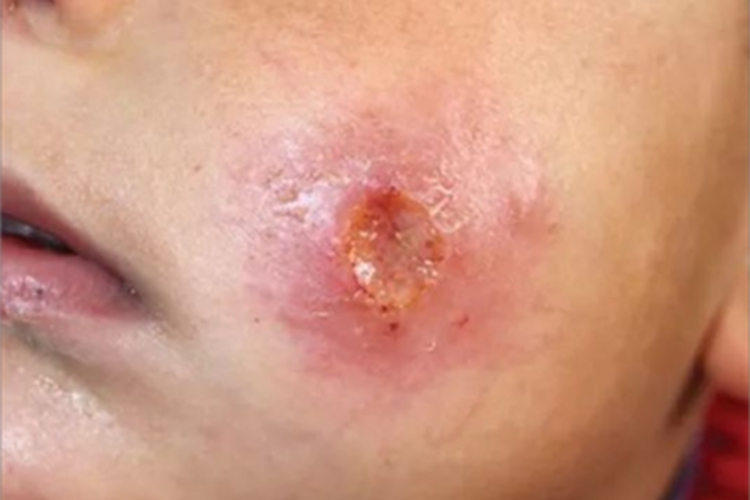 瘰疬性皮肤结核面部症状图 瘰疬性皮肤结核面部症状图