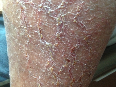 皲裂性湿疹小腿皮肤干燥脱屑裂口图