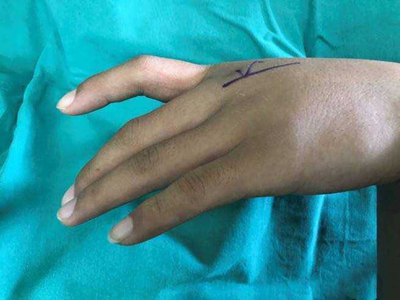 掌指关节脱位的症状和图片 - 有来医生