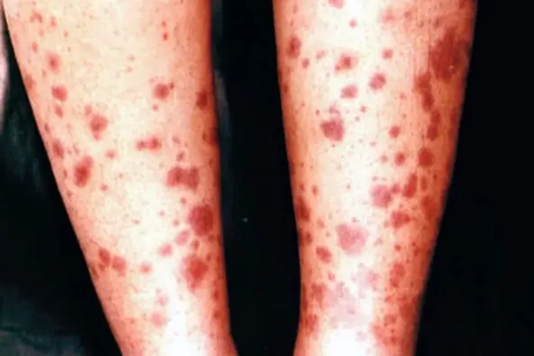 红斑狼疮腿上红斑密集图 红斑狼疮腿上红斑密集图