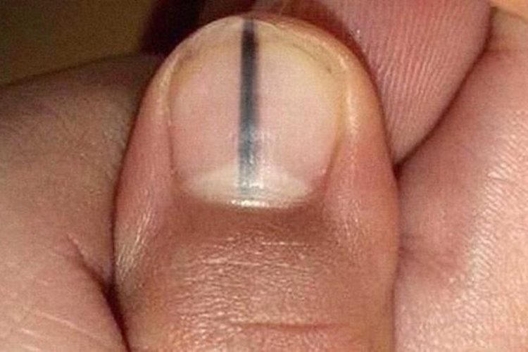 甲下黑色素瘤图