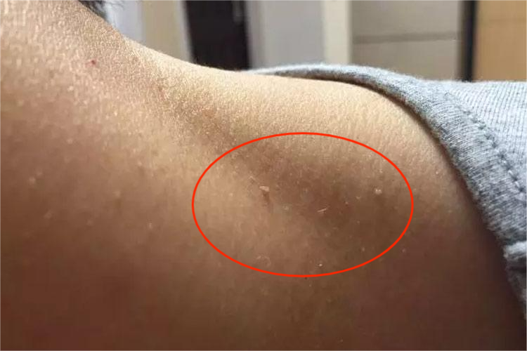 侧颈丝状型软纤维瘤图