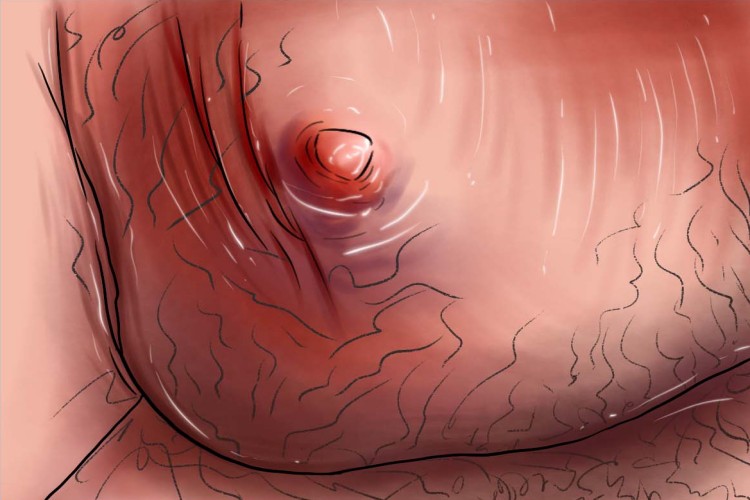 阴囊急性蜂窝织炎图 阴囊急性蜂窝织炎图