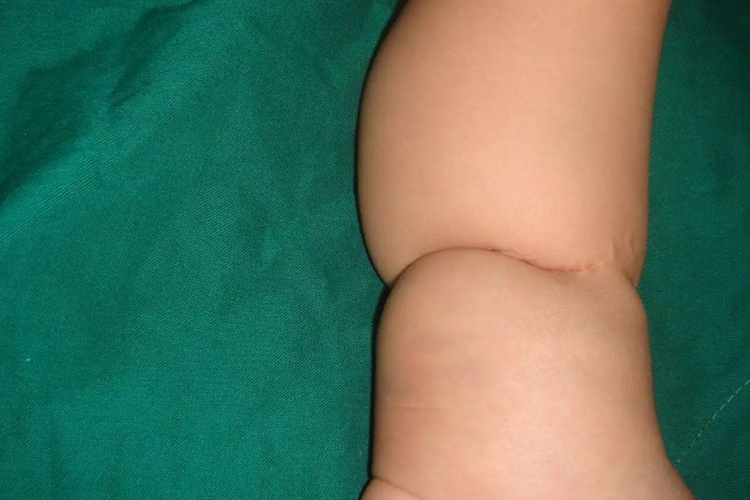 羊膜束带综合征患儿图