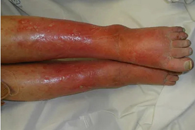 嗜酸性蜂窝织炎小腿红肿图 嗜酸性蜂窝织炎小腿红肿图