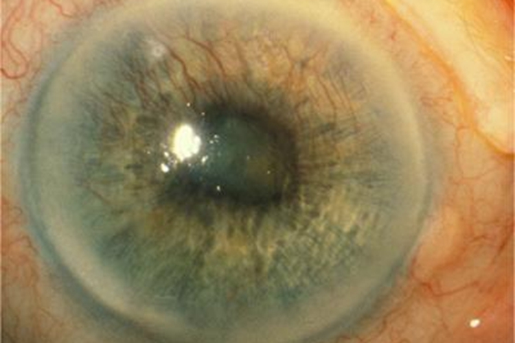 新生血管性青光眼眼球症状图
