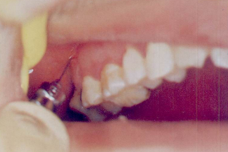 上牙槽后神经局麻图 上牙槽后神经局麻图