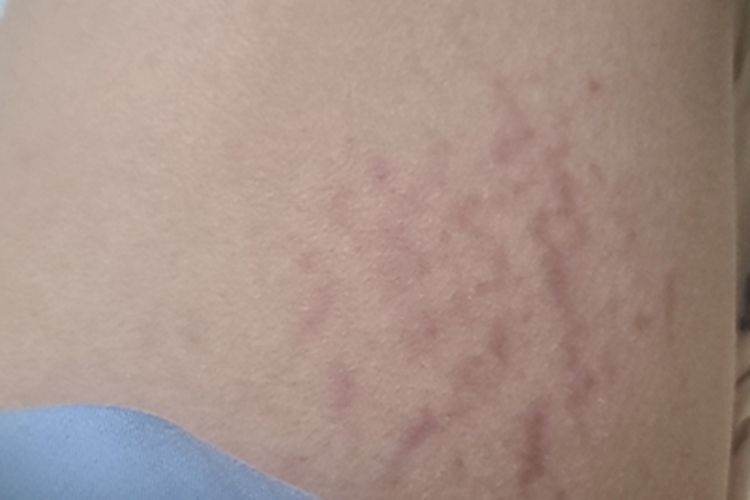 萎缩纹大腿内侧有许多纹路图 萎缩纹大腿内侧有许多纹路图