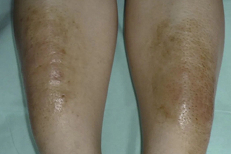 黏液性水肿小腿长斑图 黏液性水肿小腿长斑图