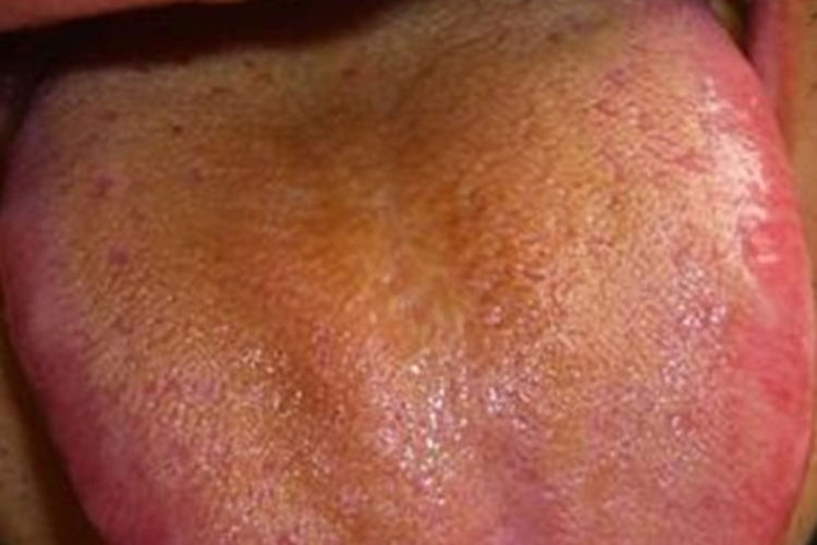 深黄舌苔图 深黄舌苔图