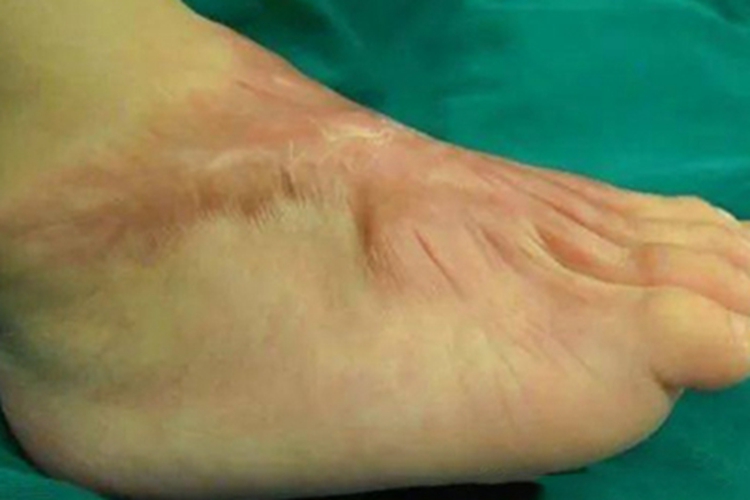 二度烫伤疤痕图