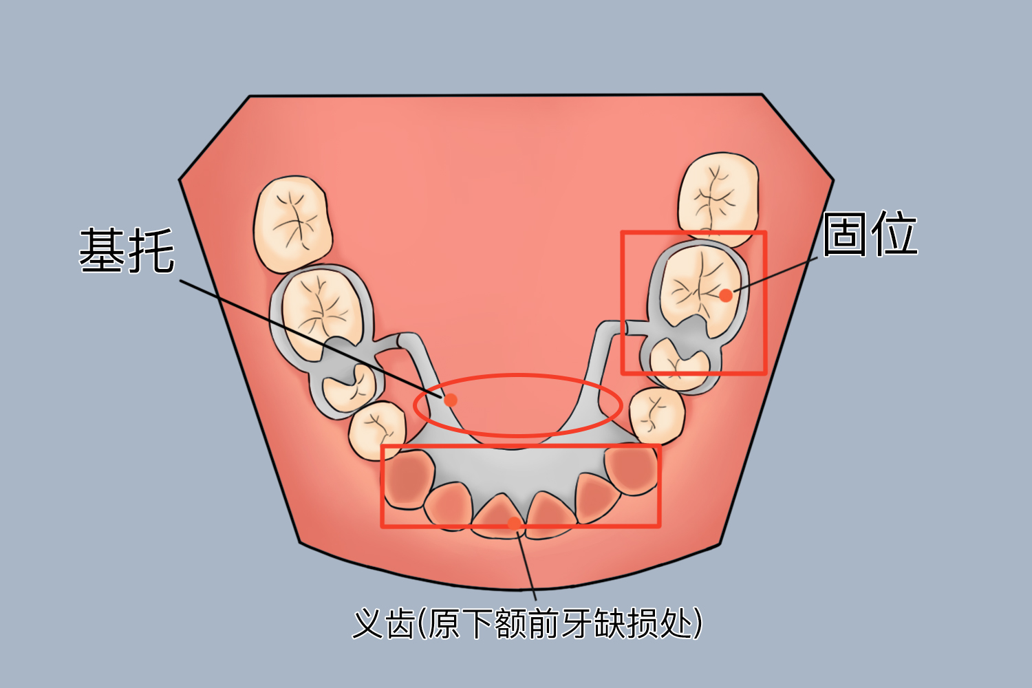 下颌前牙缺损可摘义齿设计图 下颌前牙缺损可摘义齿设计图