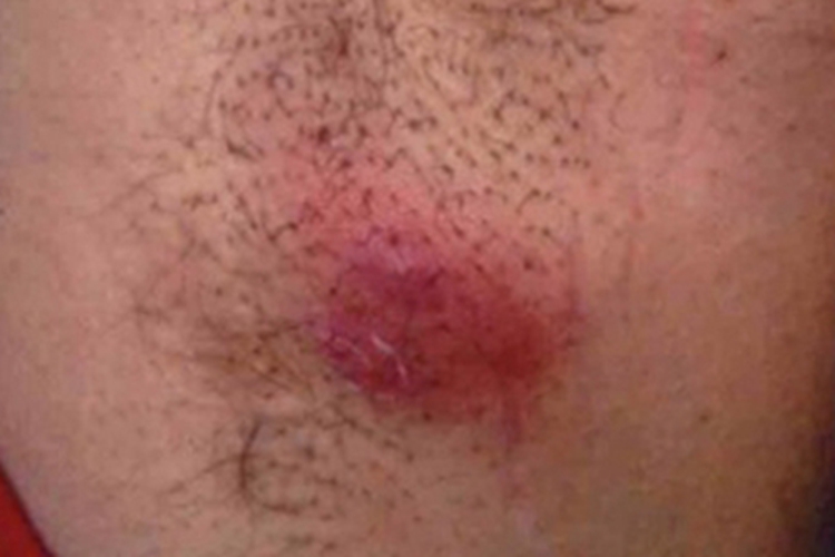 化脓性汗腺炎腋窝大红疙瘩图
