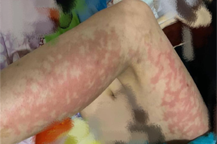 热激红斑症状图