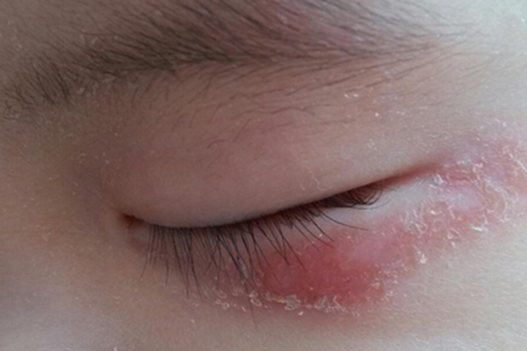 奶癣眼周脱屑图