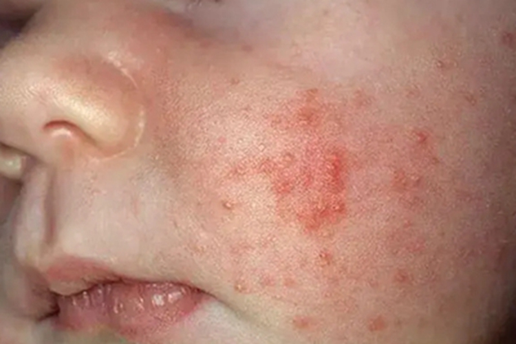 新生儿红斑面部有小红疙瘩图