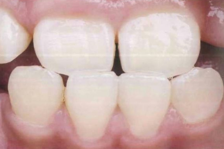正常牙齿图