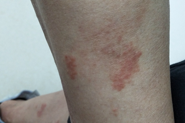 急性湿疹小腿聚集性红斑图