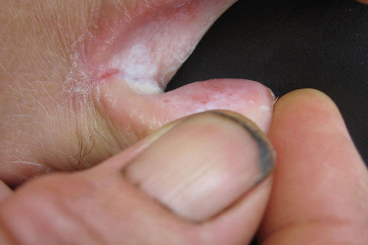 足癣-浸渍糜烂型图