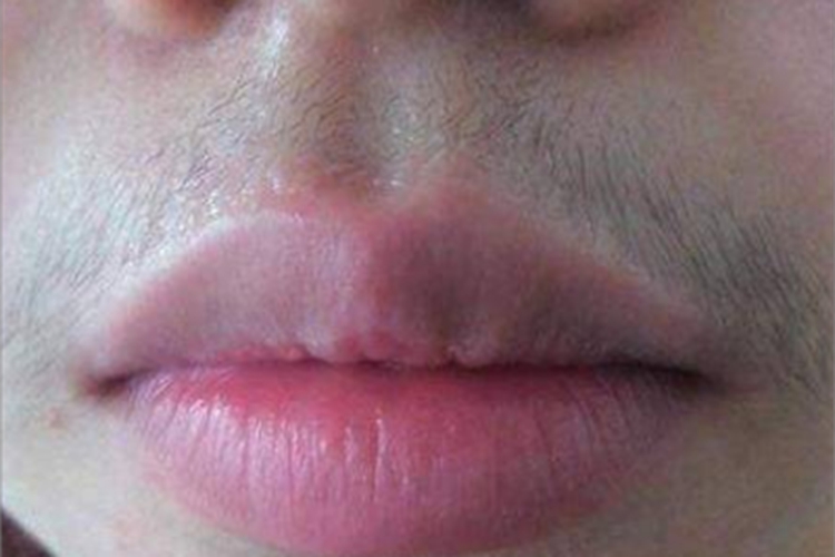多毛症口周症状图 多毛症口周症状图