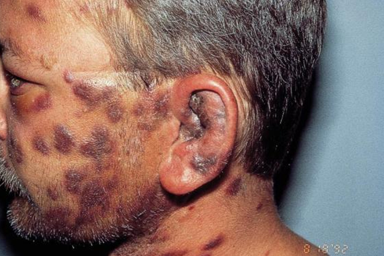 艾滋病面部卡波西肉瘤图