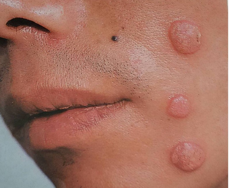 男性早期梅毒红斑图片图片