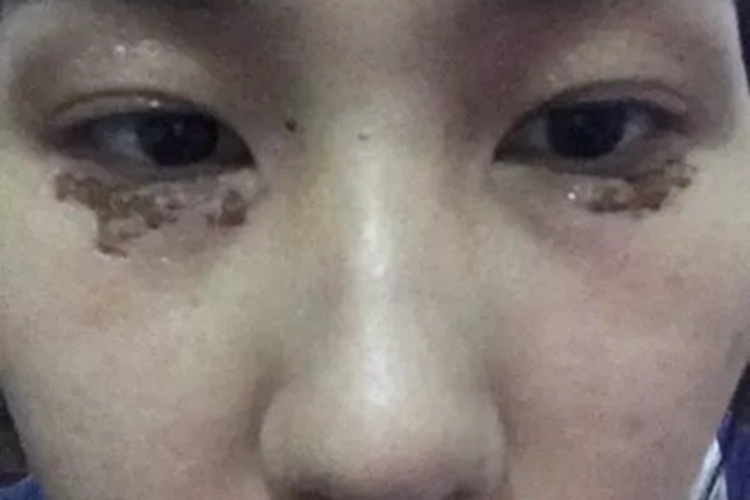 汗腺瘤眼睑激光后结痂图