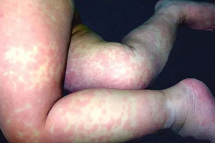 界限类偏瘤型麻风症状图 界限类偏瘤型麻风症状图